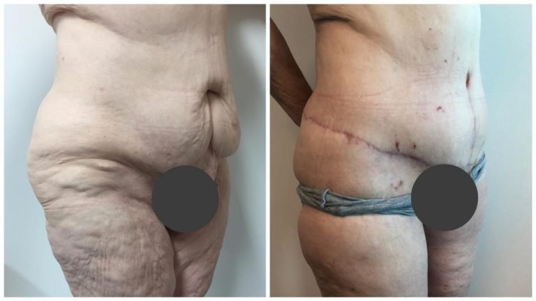 Patient 1, angle view, body lift surgery in the Gold Coast, Dr Sawhney