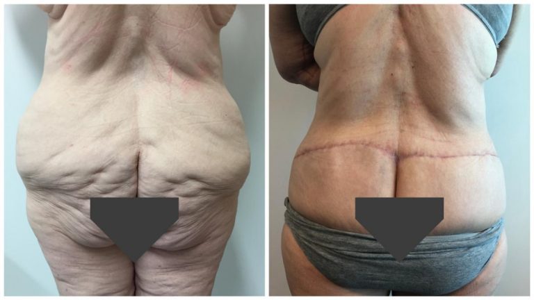 Patient 1, body lift buttocks, before & after, Sculpted Clinic