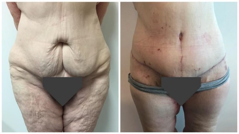 Dr Sawhney, body lift patient 1 before and after surgery, front view