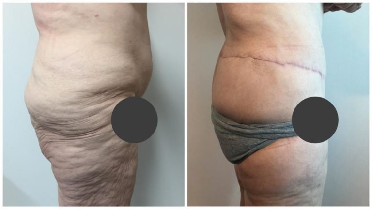 Before & afters, patient 1, side view, body lift surgery, Sculpted Clinic