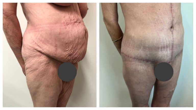 Patient 2 angle, body lift surgery with Dr Sawhney, before & after gallery