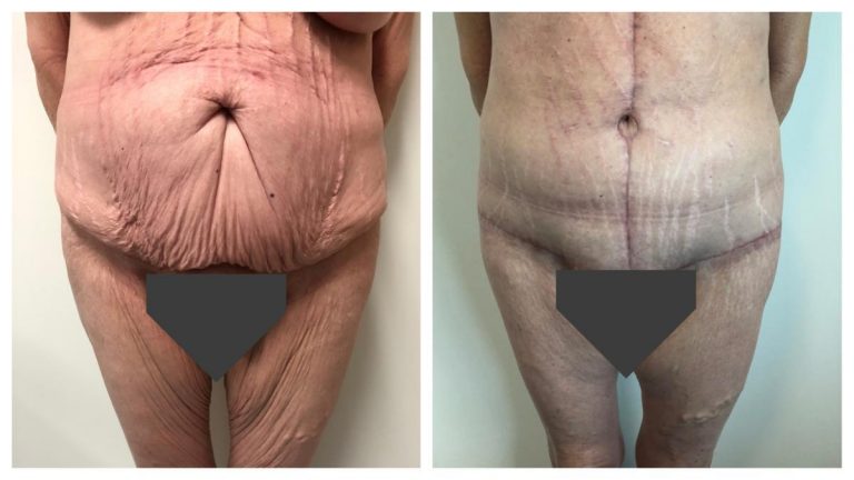 Dr Sawhney, body lift patient 2, front view