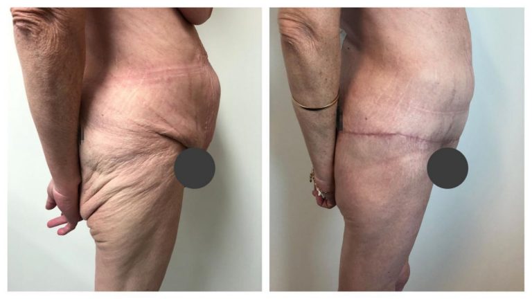 Patient 2 before and after body lift at Sculpted Clinic (Dr Sawhney), side view