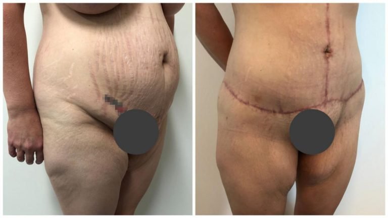Before and after a body lift, patient 3, angle view, Sculpted Clinic