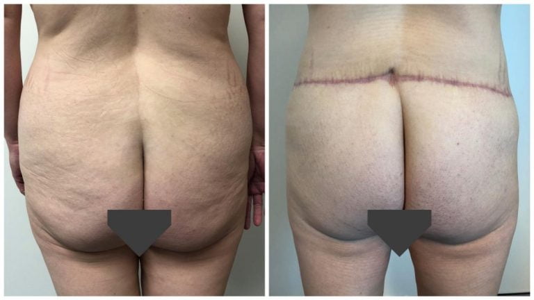 Before & afters at Sculpted Clinic, patient 3 buttocks - body lift surgery