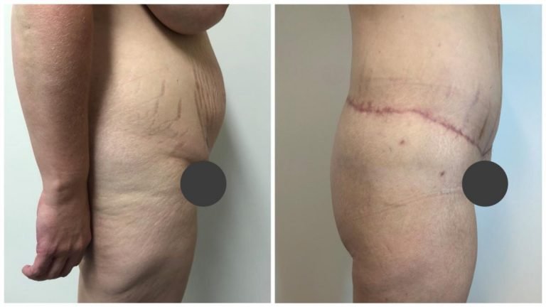 Sculpted Clinic body lift patient 3, side view, Dr Sawhney