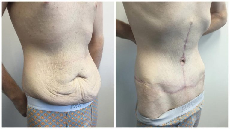 Body lift surgery patient 4, angle view, Sculpted Clinic Gold Coast
