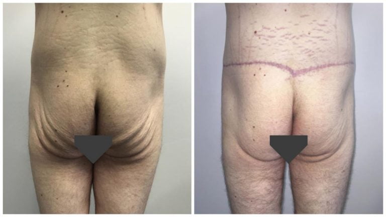 Body lift surgery patient 4, buttocks, before and after surgery