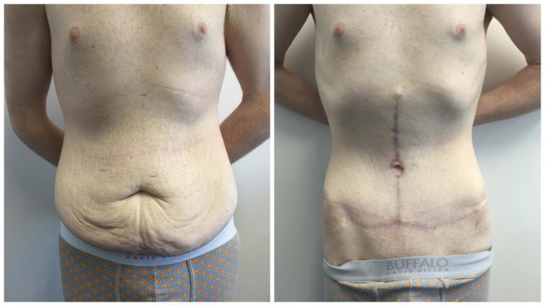 Body lift patient 4 front, before and after, Dr Sawhney Gold Coast