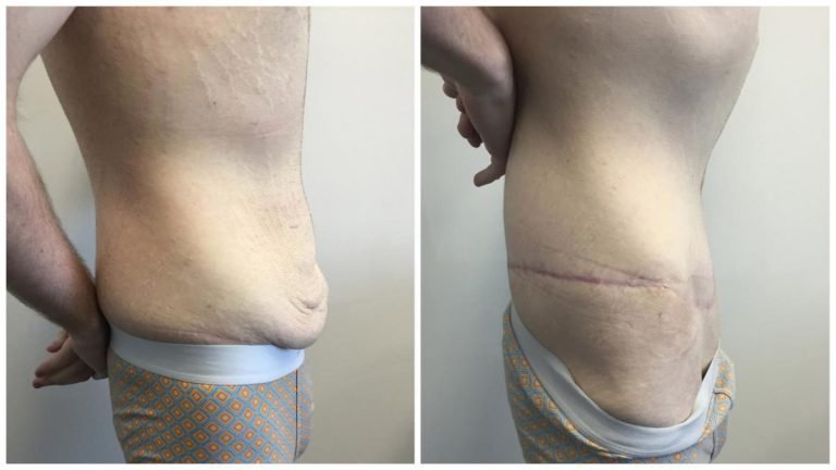 Before & after gallery, patient 4 side, body lift with Dr Sawhney