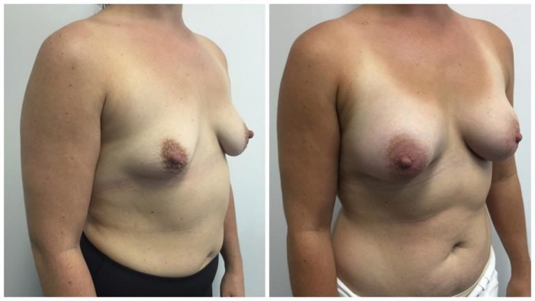 Breast implants B&A, patient 11, angle view, Dr Sawhney