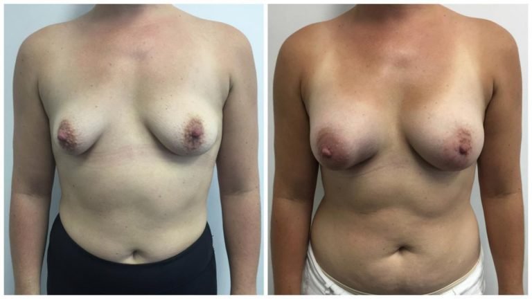 Breast augmentation Gold Coast, patient 11, front view