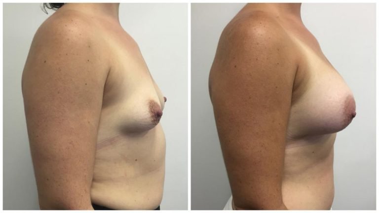 Before & afters, breast implants surgery, patient 11, side view