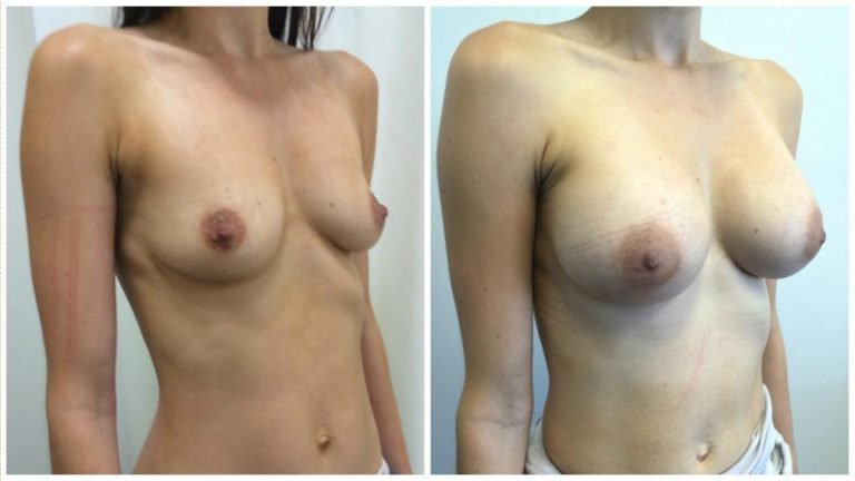 Breast implants gallery, patient 12, angle view