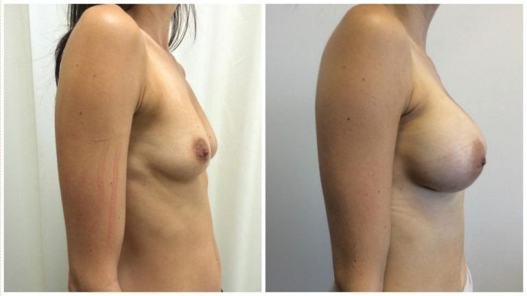 Patient before and after breast implants surgery 12, side view, Dr Sawhney