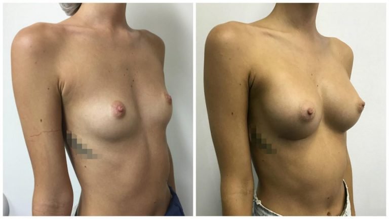 Breast augmentation surgery with implants, patient 14, angle view