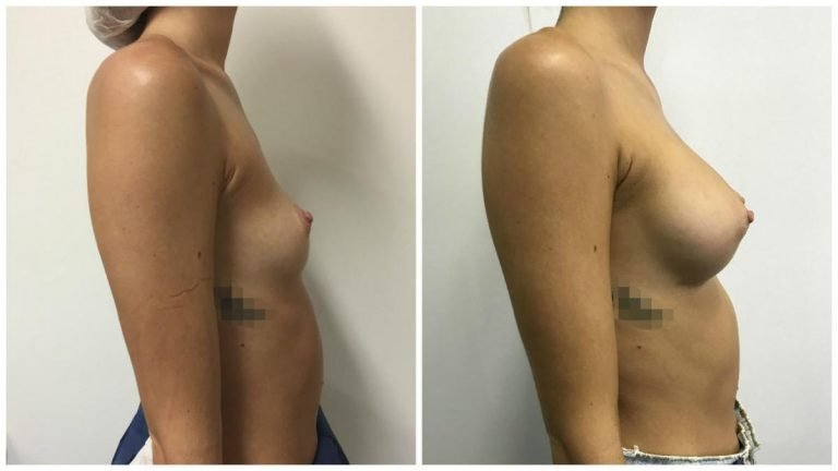 Breast augmentation patient 14, side view, Dr Sawhney