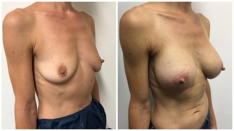 Breast implants before & after, Dr Sawhney, patient 16 angle view