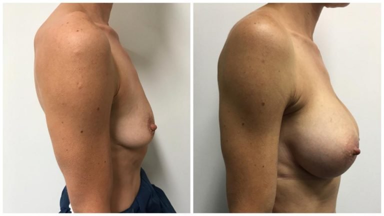 Breast augmentation mammoplasty, Gold Coast, patient 16, side view