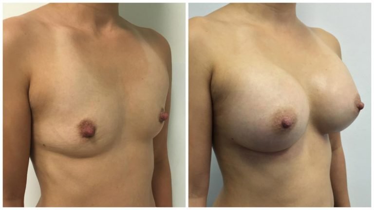 Breast implants surgery patient 2, angle view
