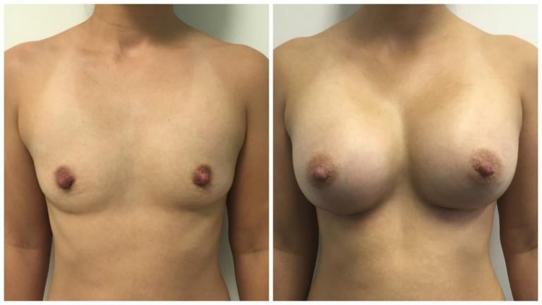 Breast augmentation patient 2, front view, Dr Sawhney