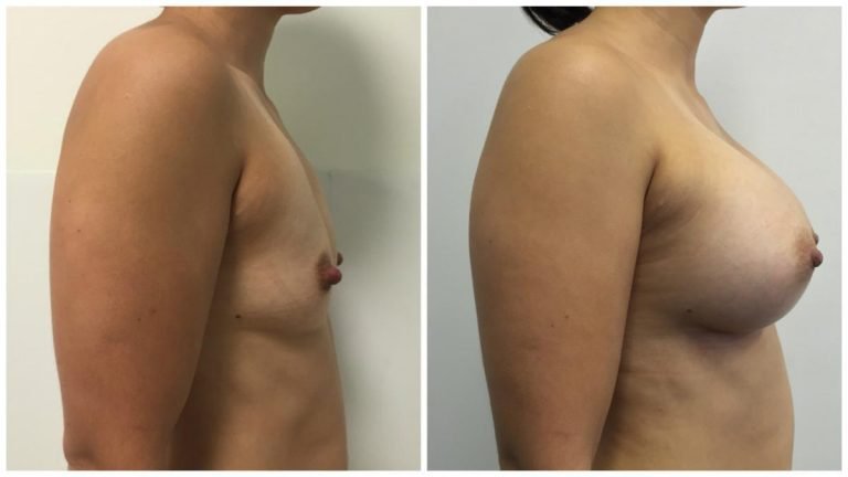 Dr Sawhney, patient 2, before & after breast augmentation surgery, side view