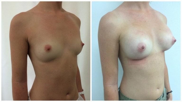 Breast augmentation, patient 3, angle view