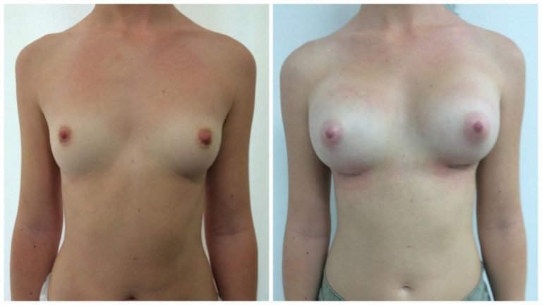 Breast augmentation with implants, patient 3, front view