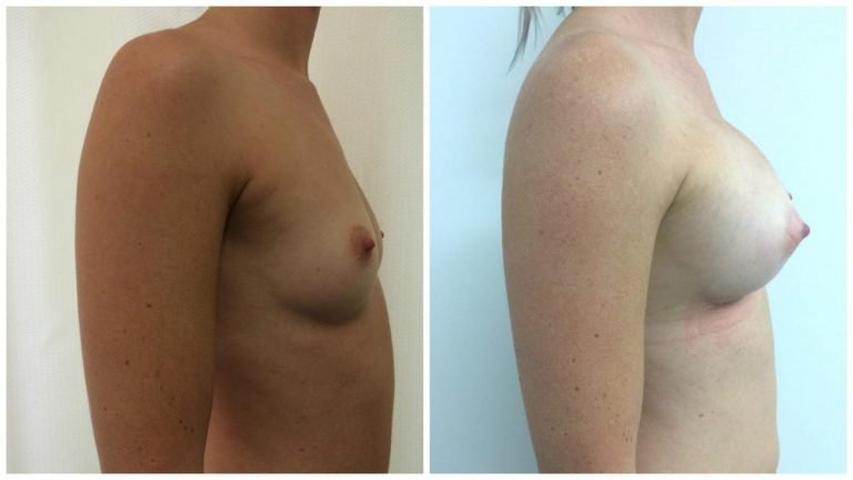 Patient 3 before & after breast implants surgery, side view