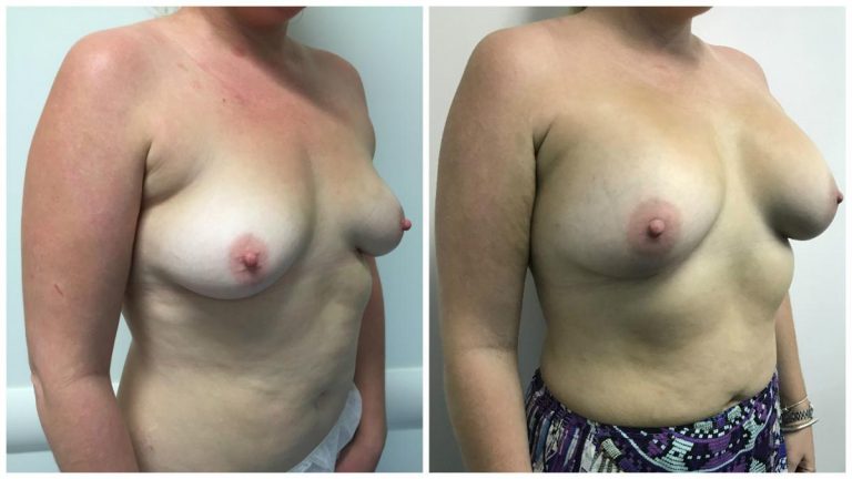 Breast implants surgery, patient 4, angle view