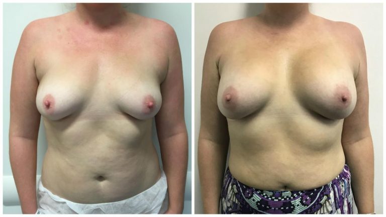 Breast augmentation, patient 4, Dr Sawhney, front view