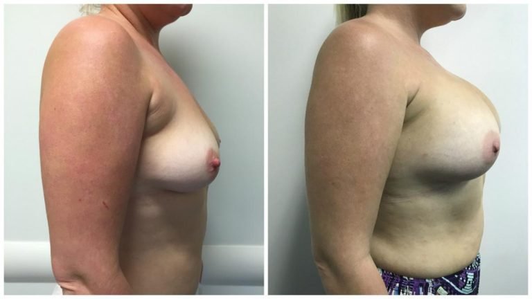 Patient 4 before & after breast augmentation, side view