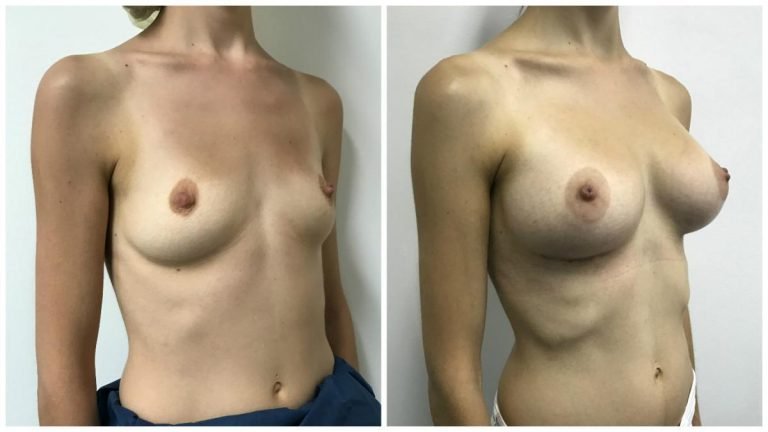 Breast augmentation patient 5, angle view, before & after