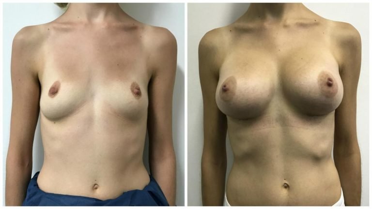 Breast implants surgery, patient 5, before & afters, front view