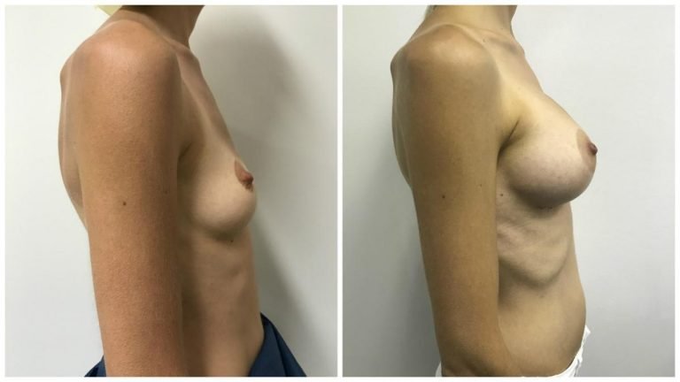 Breast implants patient 5, side view, Dr Sawhney