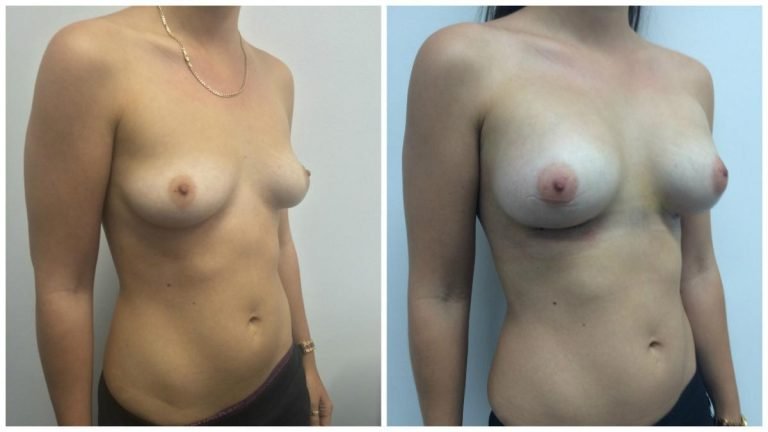 Patient 7 before & after breast augmentation, angle view