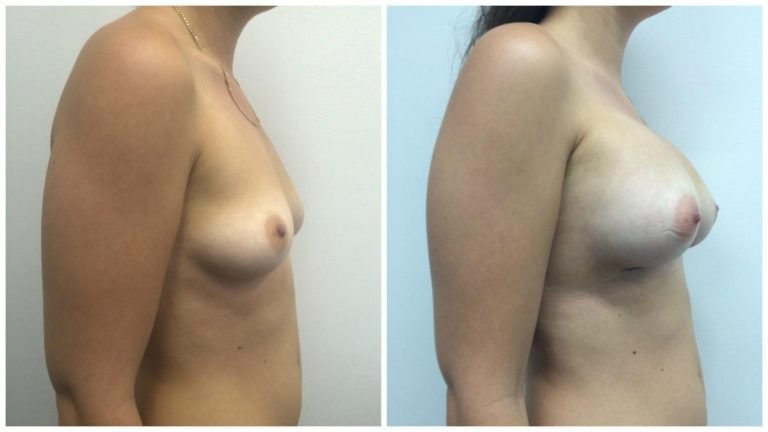 Breast implant surgery, patient 7, side view