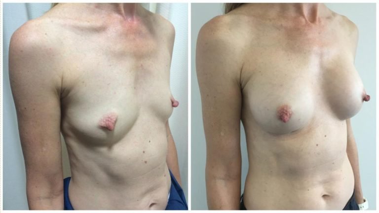 Breast augmentation patient 8, angle view