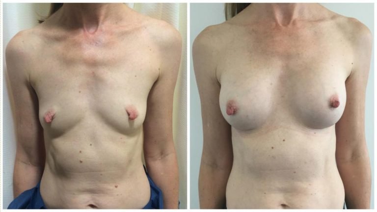 Breast implants surgery, patient 8, front view
