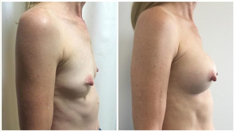 Dr Sawhney Gold Coast, breast augmentation surgery patient 8, side view