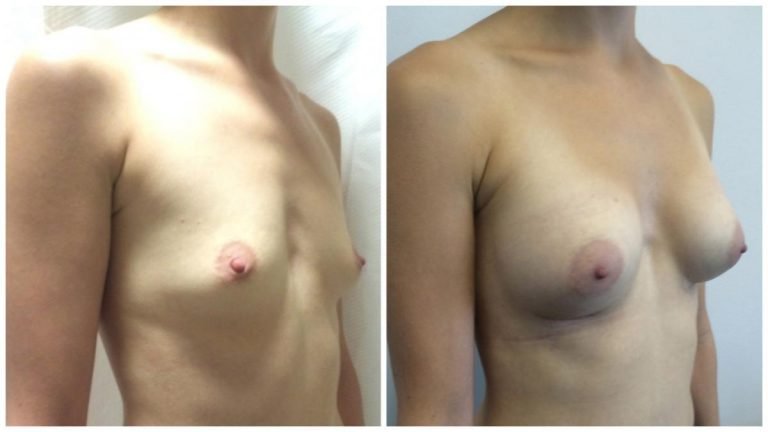 Patient 9 before and after breast implants, Dr Sawhney, angle view