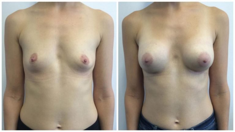 Patient 9, breast implants surgery before & after, front view