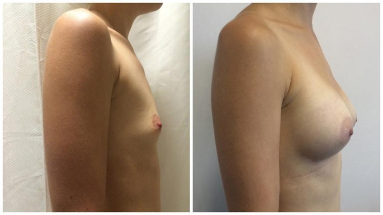 Breast augmentation with implants, patient 9, side view