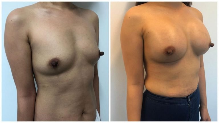 Patient before & after breast augmentation with implants 19, angle view