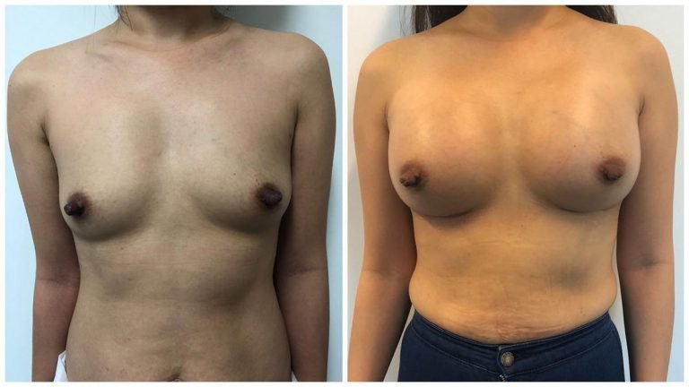 Breast augmentation with implants, patient 19, front view