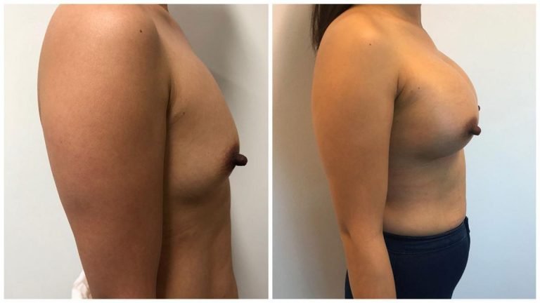 Breast augmentation with implants surgery before & after, patient 19 side view
