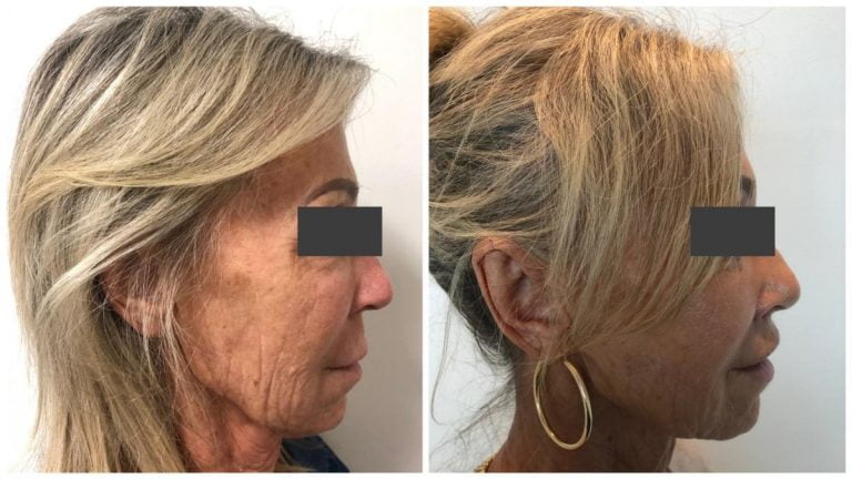 Face lip lift 01-3, before and afters, Dr Sawhney Gold Coast