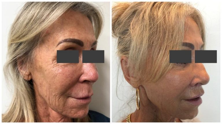 Face lip lift, before and after 01-2, angle view