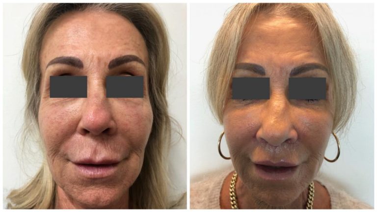 Face lip lift surgery results, patient 01, front view, Sculpted Clinic