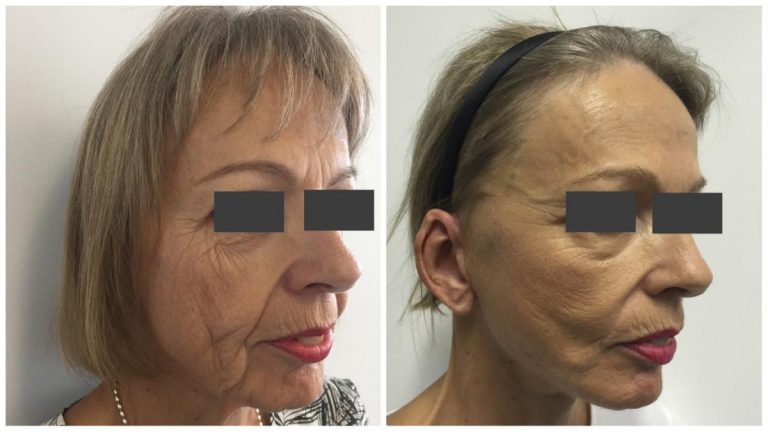 Facelift before and after 1, angle view